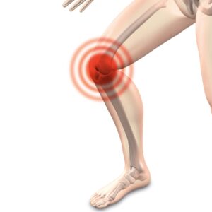 arthrocalman, osteoarthritis, knee-2384253.jpg